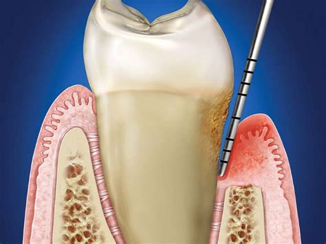 bolsa periodontal